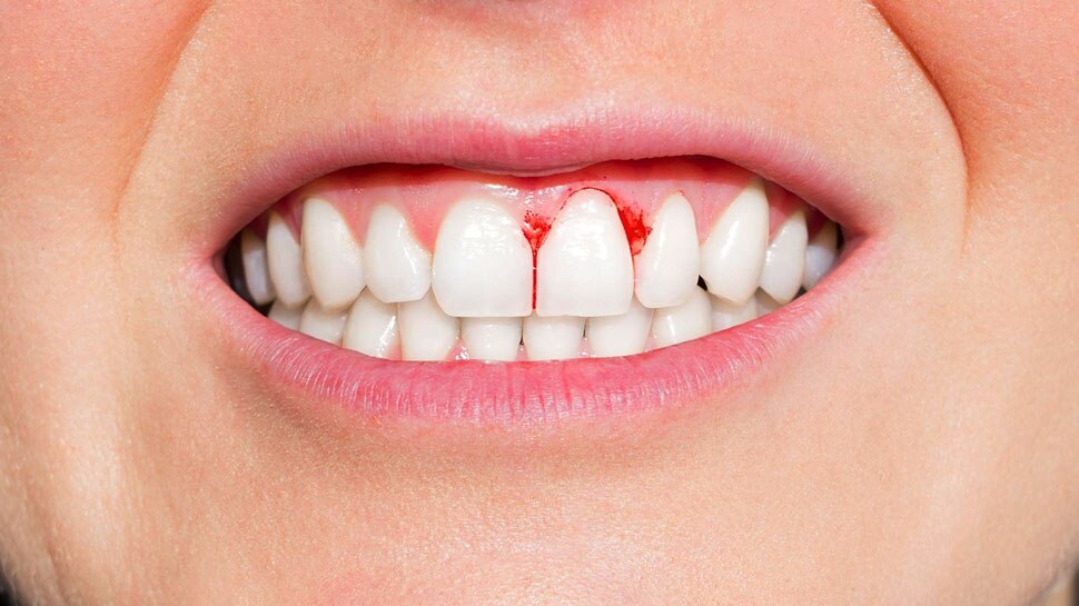 Gum Bleeding: जब मसूड़ों से आने लगा खून, तो झट से करें ये 3 उपाय, जल्द मिलेगा आराम