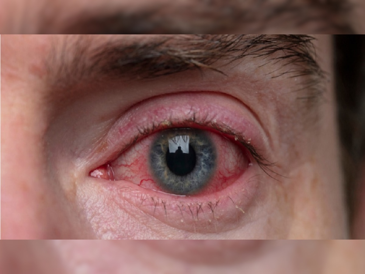 Red Eyes Causes: आंखें लाल होने के जान ले मुख्य कारण, हो सकती हैं गंभीर समस्याएं