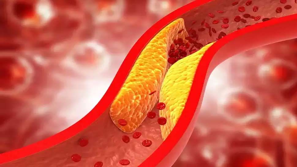 Cholesterol: कोलेस्ट्रॉल बढ़ने पर महसूस होती हैं ये दिक्कतें, नजरअंदाज करना पड़ सकता है सेहत पर भारी
