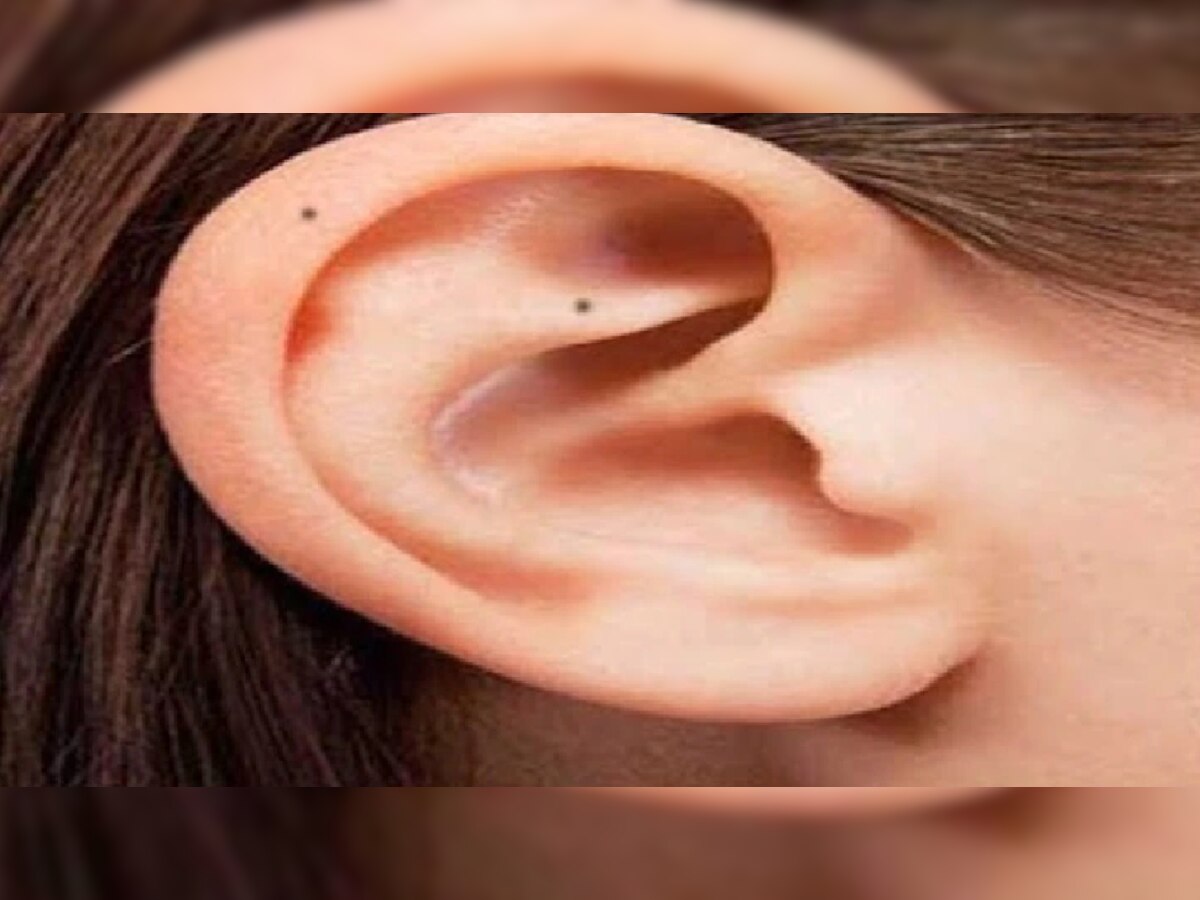 Lucky mole on body meaning these parts of moles in body consider lucky