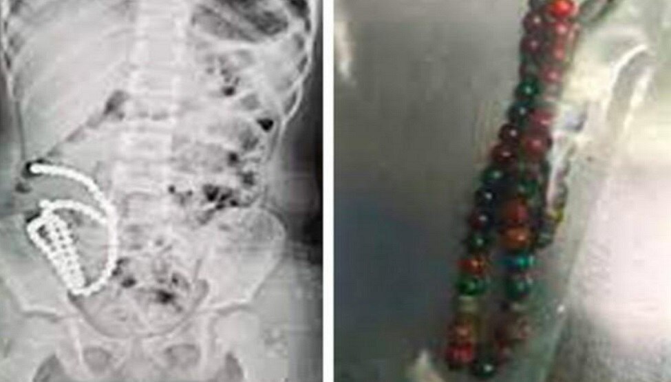 Magnetic Beads: बच्ची के पेट से डॉक्टरों ने निकाले 61 कंचे, X-RAY देखकर ही बेहोश हो गए पैरेंट्स