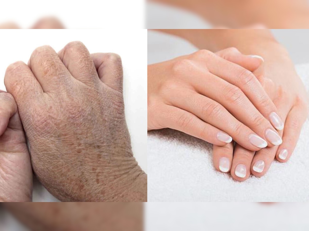 Dry skin home remedies: फटे हुए हाथों को मुलायम बनाने के लिए लगा लें ये होममेड ग्लिसरीन; चमक जाएगी स्किन