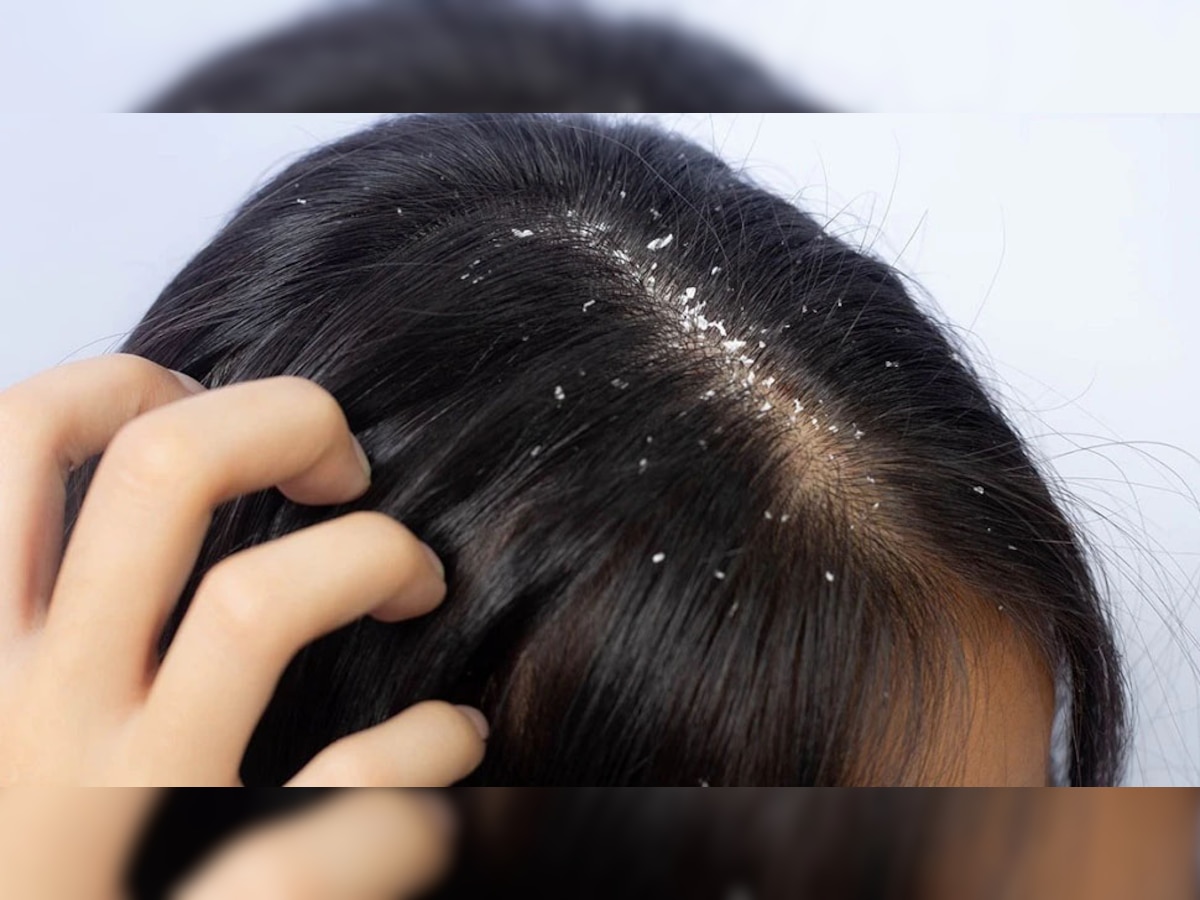 Dandruff Removal Tips: सर्दियों में इन 4 वजहों से होता है बालों में डैंड्रफ, जान लें कारण और उनसे बचने के ये आसान उपाय