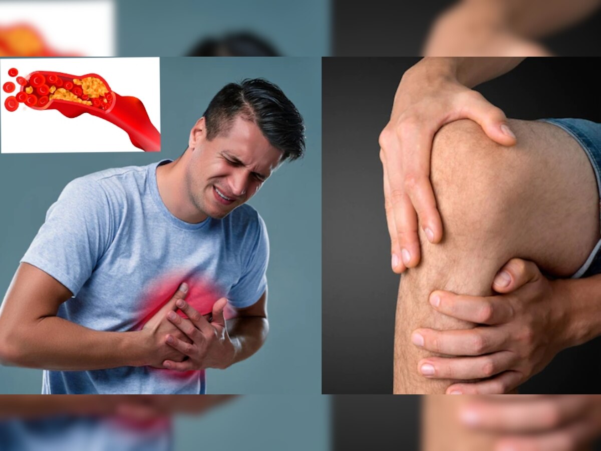 High Cholesterol Leg Pain