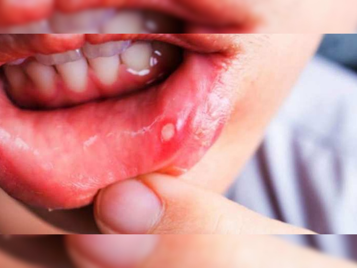 Mouth Ulcer Home Remedies: मुंह में बार-बार छाले निकलने से हो चुके हैं परेशान? तुरंत आजमा लें ये फायदेमंद घरेलू उपाय 