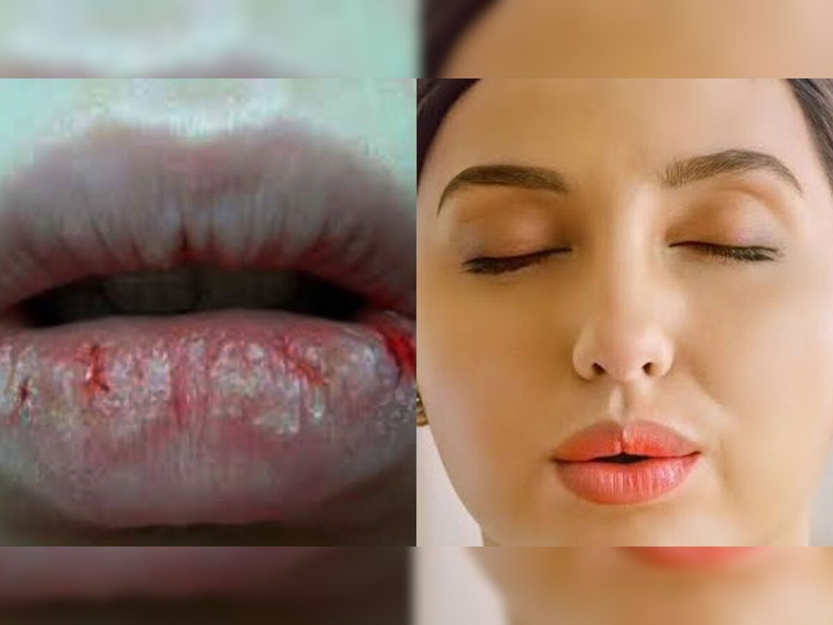 Dry Lips: सर्दियों के मौसम में इन वजहों से फटते हैं होंठ, ऐसे पाएं Nora Fatehi जैसे खूबसूरत लिप्स