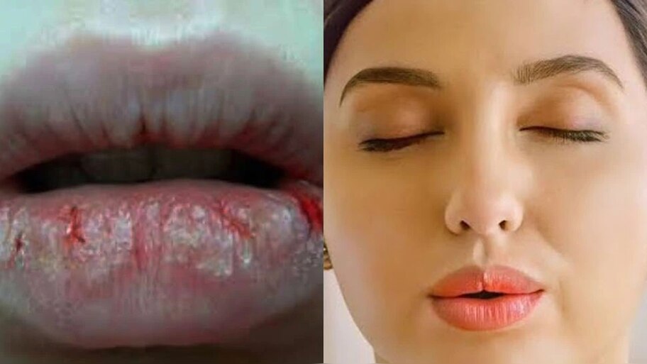 Dry Lips: ଶୀତ ଦିନେ ଫାଟୁଛି କି ଆପଣଙ୍କ ଓଠ ? କରନ୍ତୁ ନାହିଁ ଭୁଲରେ ଏପରି କାମ