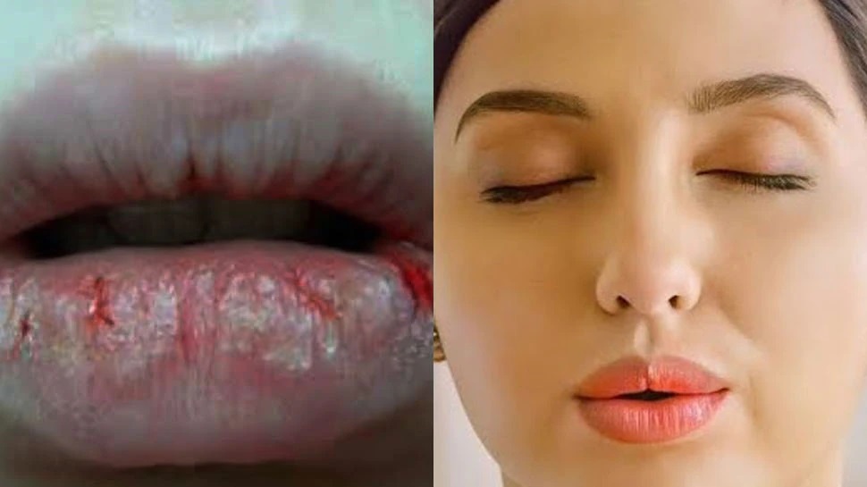 Dry Lips: ଶୀତ ଦିନେ ଫାଟୁଛି କି ଆପଣଙ୍କ ଓଠ ? କରନ୍ତୁ ନାହିଁ ଭୁଲରେ ଏପରି କାମ Dry Lips: ଶୀତ ଦିନେ ଫାଟୁଛି କି ଆପଣଙ୍କ ଓଠ ? କରନ୍ତୁ ନାହିଁ ଭୁଲରେ ଏପରି କାମ