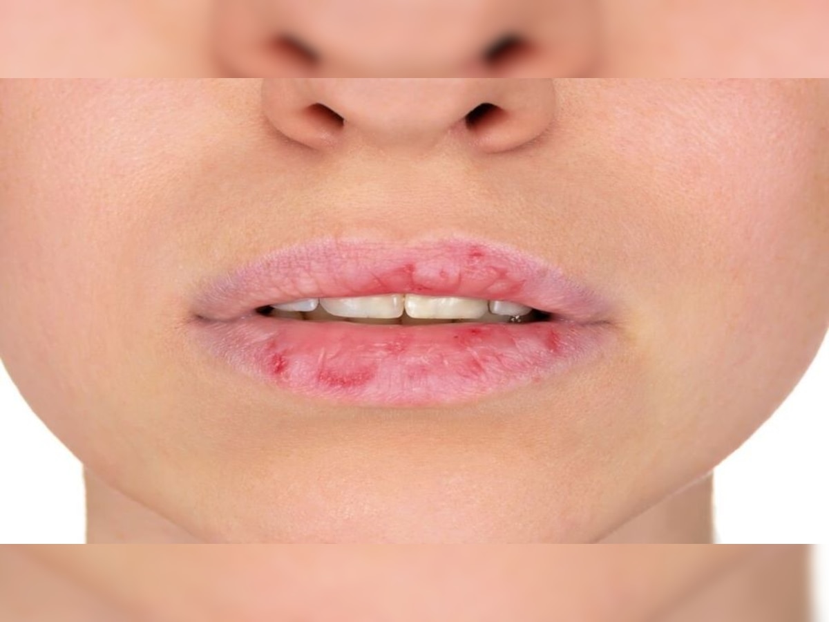 Cracked Lips: सर्दियों में बार-बार फट रहे हैं लिप्स? अजमाएं ये नुस्खे, Nora Fatehi जैसे होंगे होंठ