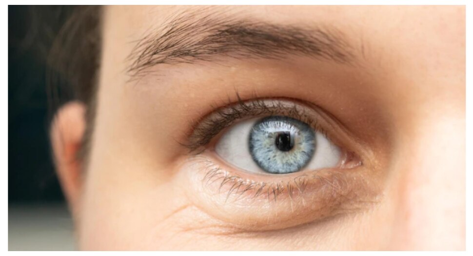 home remedies to get rid of puffy eyes Swelling Puffy Eyes आंखों की