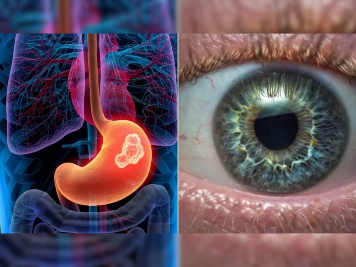 Cancer Sign in Eyes: आंखों में दिख जाता है कैंसर का ये खतरनाक लक्षण, ये 8 संकेत दिखते ही हो जाएं सावधान