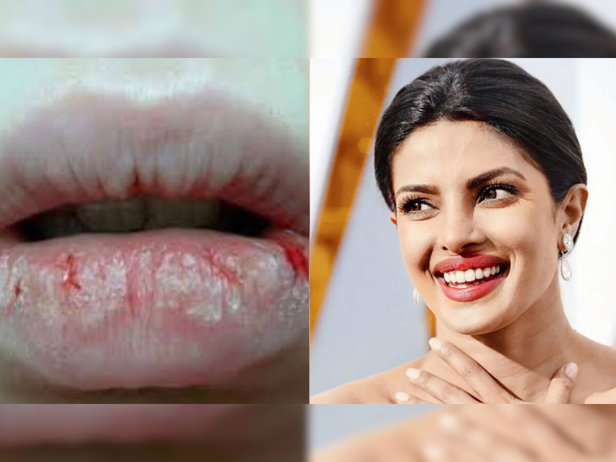 Dead Skin On Lips: होंठों से इस तरह हटाएं डेड स्किन, Priyanka Chopra जैसे हसीन हो जाएंगे लिप्स
