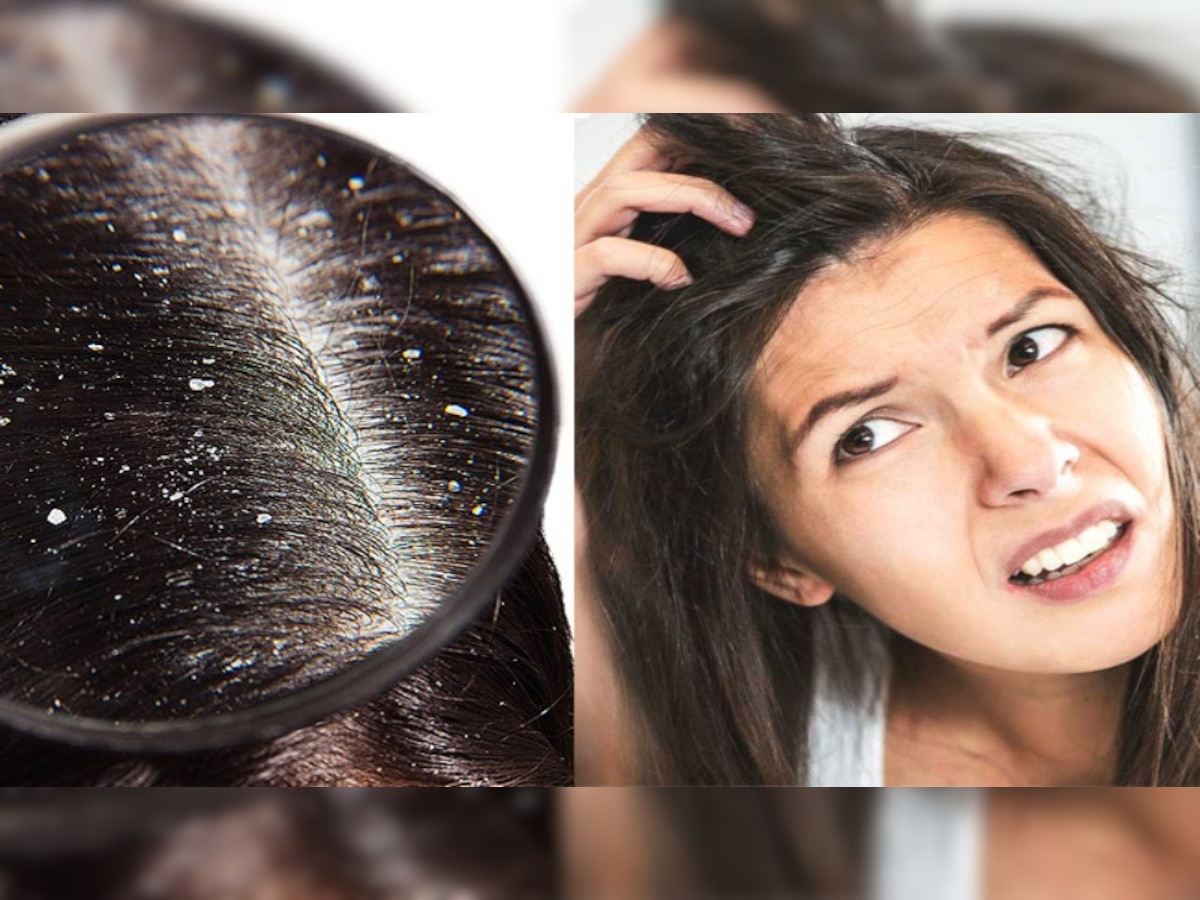 How To Get Rid Of Dandruff: डैंड्रफ का रामबाण इलाज है रीठा, इस विधि को अपनाकर झट से दूर भगाएं 