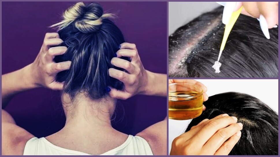 Scalp itching Treatment Effective Home Remedies Dandruff in head sir ki khujli ka ilaj sdmp | Scalp Itching Treatment: सिर की खुजली पका देती है दिमाग? ये घरेलू उपाय करेंगे आपकी मदद | Scalp itching Treatment Effective Home Remedies Dandruff in head sir ki khujli ka ilaj sdmp | Scalp Itching Treatment: सिर की खुजली पका देती है दिमाग? ये घरेलू उपाय करेंगे आपकी मदद |