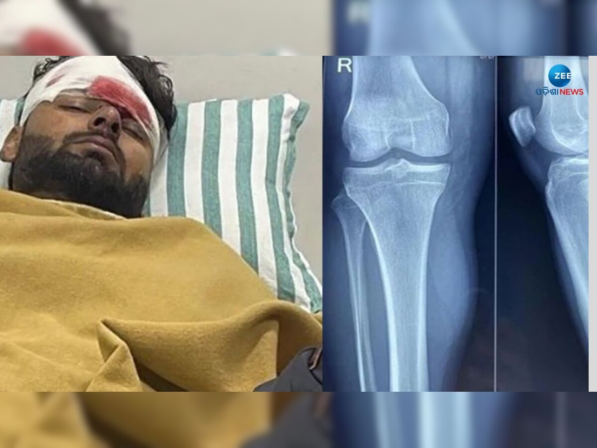Rishabh Pant Accident: ଋଷଭଙ୍କ ଆଣ୍ଠୁରେ Ligament Injuries, ଜାଣନ୍ତୁ ଏହା କେତେ ଭୟଙ୍କର