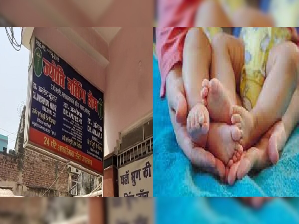 भागलपुर में सीने से सटे दो जुड़वा बच्चों का हुआ जन्म, एक झलक के लिए अस्पताल पहुंच रहे लोग