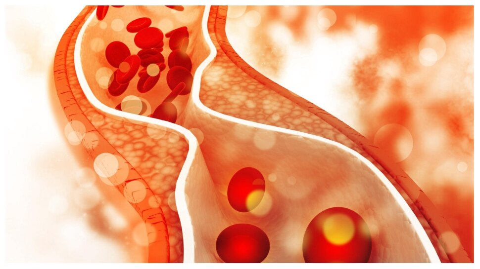 Cholesterl: सर्दियों के मौसम में भूलकर भी न करें इन चीजों का सेवन, बढ़ सकता है कोलेस्ट्रॉल