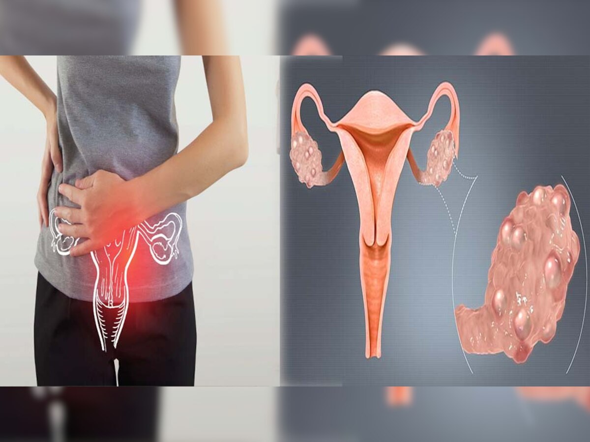 PCOS Symptoms: महिलाओं में खूब हो रहा है पीसीओएस; ये लक्षण दिखते ही तुरंत करें डॉक्टर से संपर्क