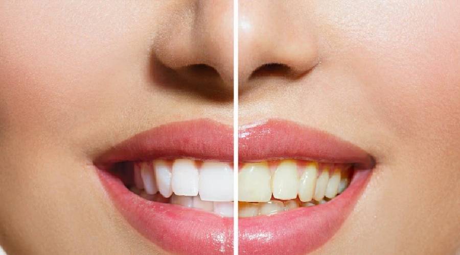 दांतों का पीलापन इन घरेलू उपाय से करें दूर, मिनटों में मोती की तरह चमकेंगे दांत
