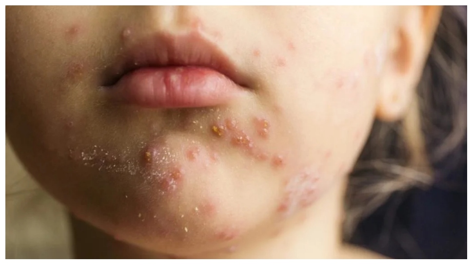 Cholesteriol Rash health tips these symptoms appear to increase the level of cholesterol ...