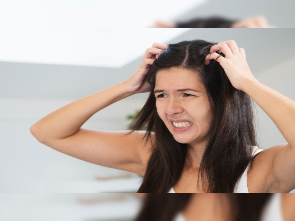 How To Get Rid Of Dandruff: रसोई में मौजूद ये 5 चीजें, दूर कर देती हैं बालों में भरी हुई रूसी