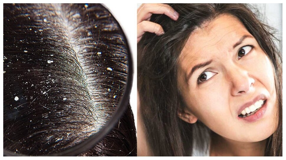health tips home remedies to get rid of dandruff in winter| Hair Care Tips:  ठंड के मौसम में डैंड्रफ की समस्या से हैं परेशान? इन तरीकों से बाल बनेंगे  सॉफ्ट और शाइनी| Hindi News