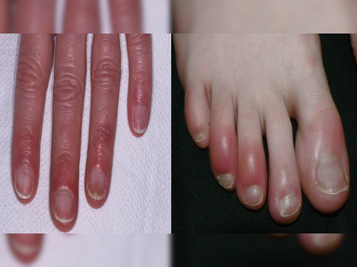 Swelling in Fingers: क्या आप भी सर्दियों में हाथ-पैरों की उंगलियां सूजने से हैं परेशान; अपनाएं ये घरेलू नुस्ख़े