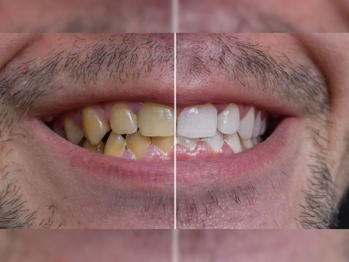 How To Get Rid Of Yellow Teeth: पीले दांतों के कारण से झेलनी पड़ती है शर्मिंदगी? ये 4 घरेलू नुस्खे आएंगे आपके काम