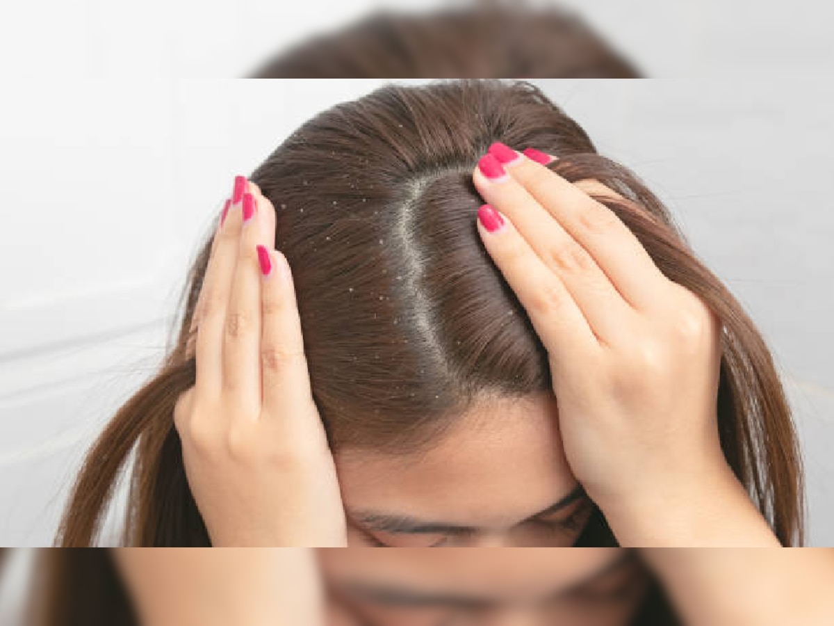 Winter Hair Care Tips: सर्दियों में बढ़ गई है डैंड्रफ, इस विधि से करें पक्का इलाज 
