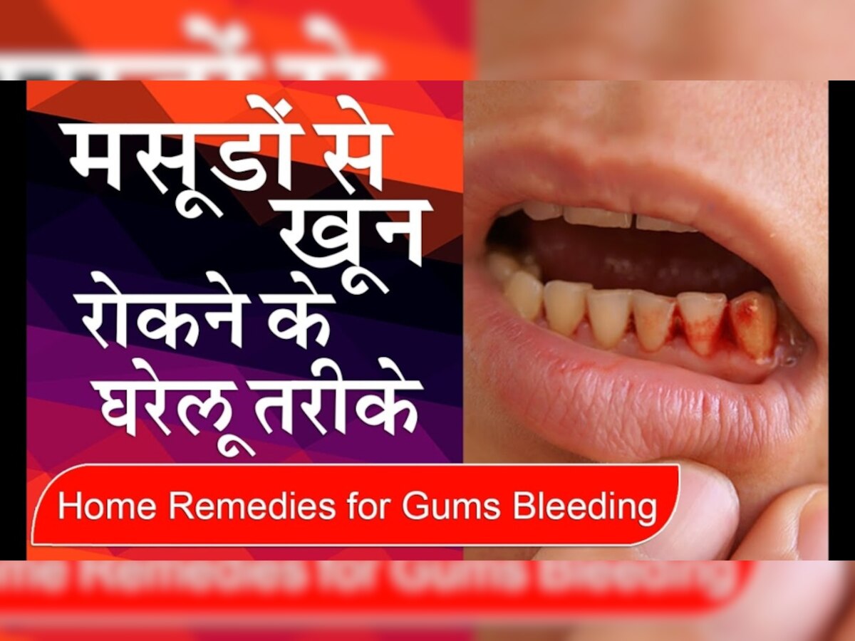 How To Stop Gum Bleeding: मसूड़ो से निकल रहा है खून? तो रोकने के लिए तुरंत आजमाएं ये घरेलू उपाय