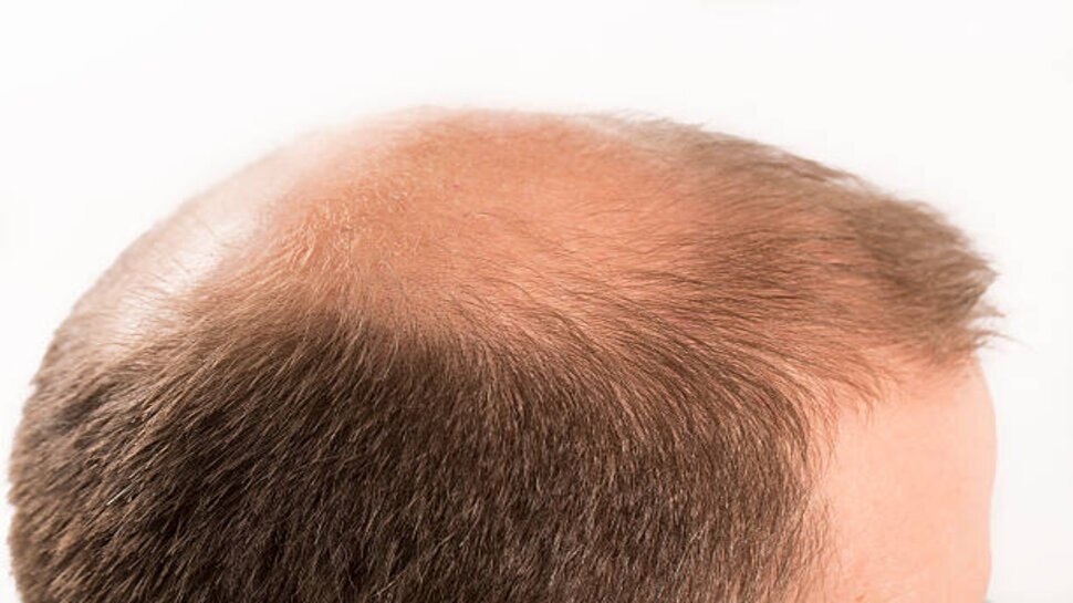 Success Story Alert New Male Hair Loss Treatment Entry