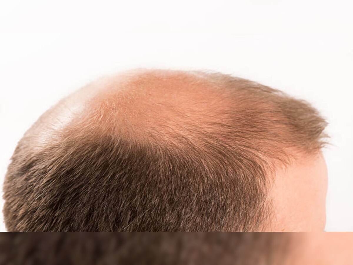  Hair loss treatment: 20 रुपये की ये चीज जवानी में कर रही है गंजा! हफ्ते में एक बार भी पीने से होगा नुकसान  