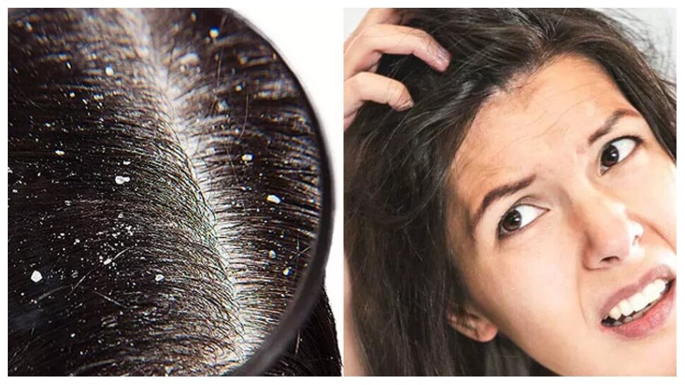 hair care tips to remove the problem of dandruff, apply this thing