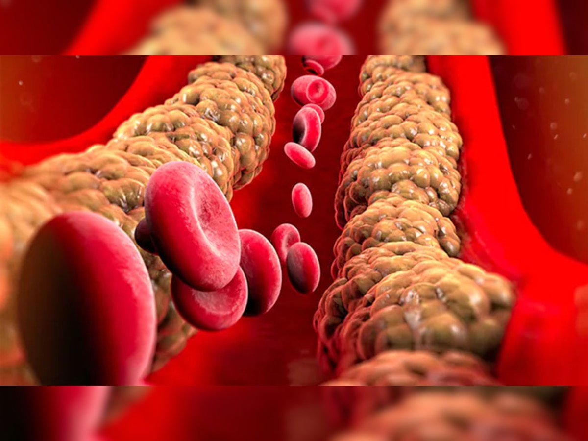 Cholesterol Control Tips: ट्राइग्लिसराइड्स और कोलेस्ट्रॉल पिघलकर शरीर से हो जाते हैं बाहर, आज ही अपना लें ये 3 आयुर्वेदिक उपाय