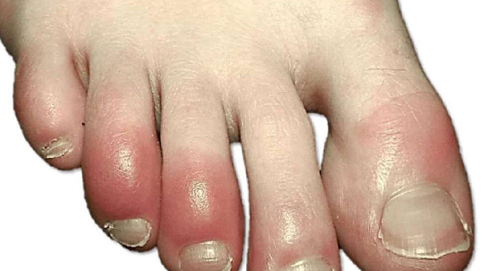 आखिर सर्दियों में क्यों आ जाती है पैर की उंगलियों में सूजन? जानें इनके मुख्य कारण