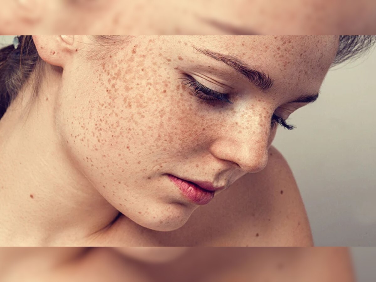 How To Get Rid Of Pigmentation: रसोई में रखी ये चीज, झाइयों को कम करके चेहरे की चमक को बढ़ा देगी