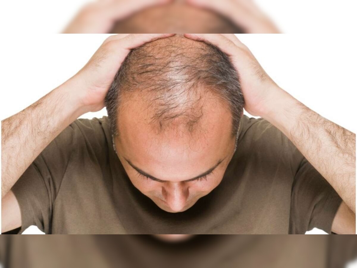 Men's Hair Care Tips: हेयर केयर में पुरुष करते हैं ये बड़ी गलती, बाल झड़ते-झड़ते गंजेपन के हो जाते हैं शिकार