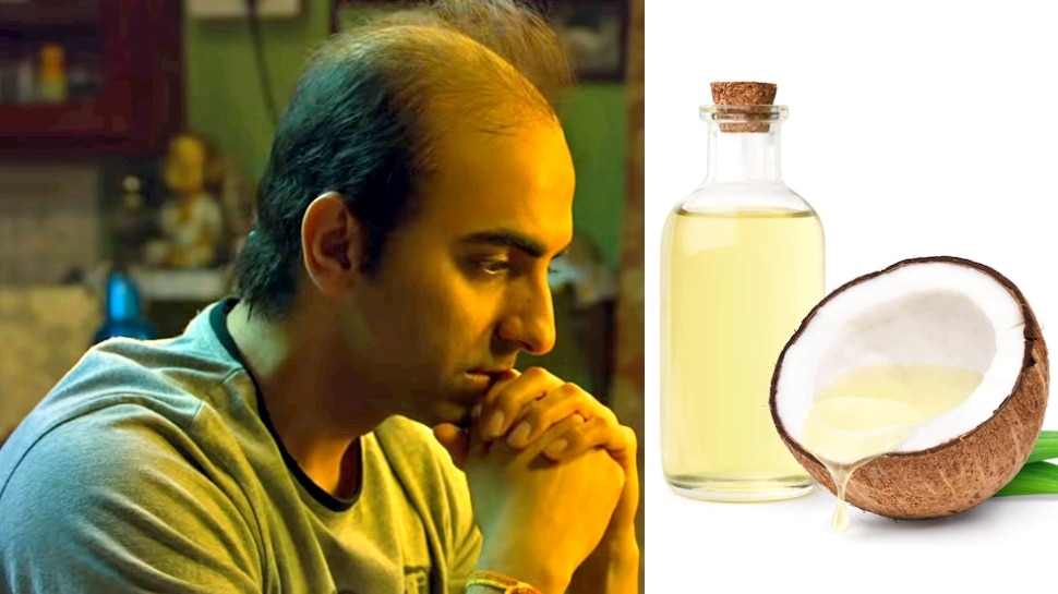 coconut oil benefits to avoid hair fall baldness hair care tips Hair