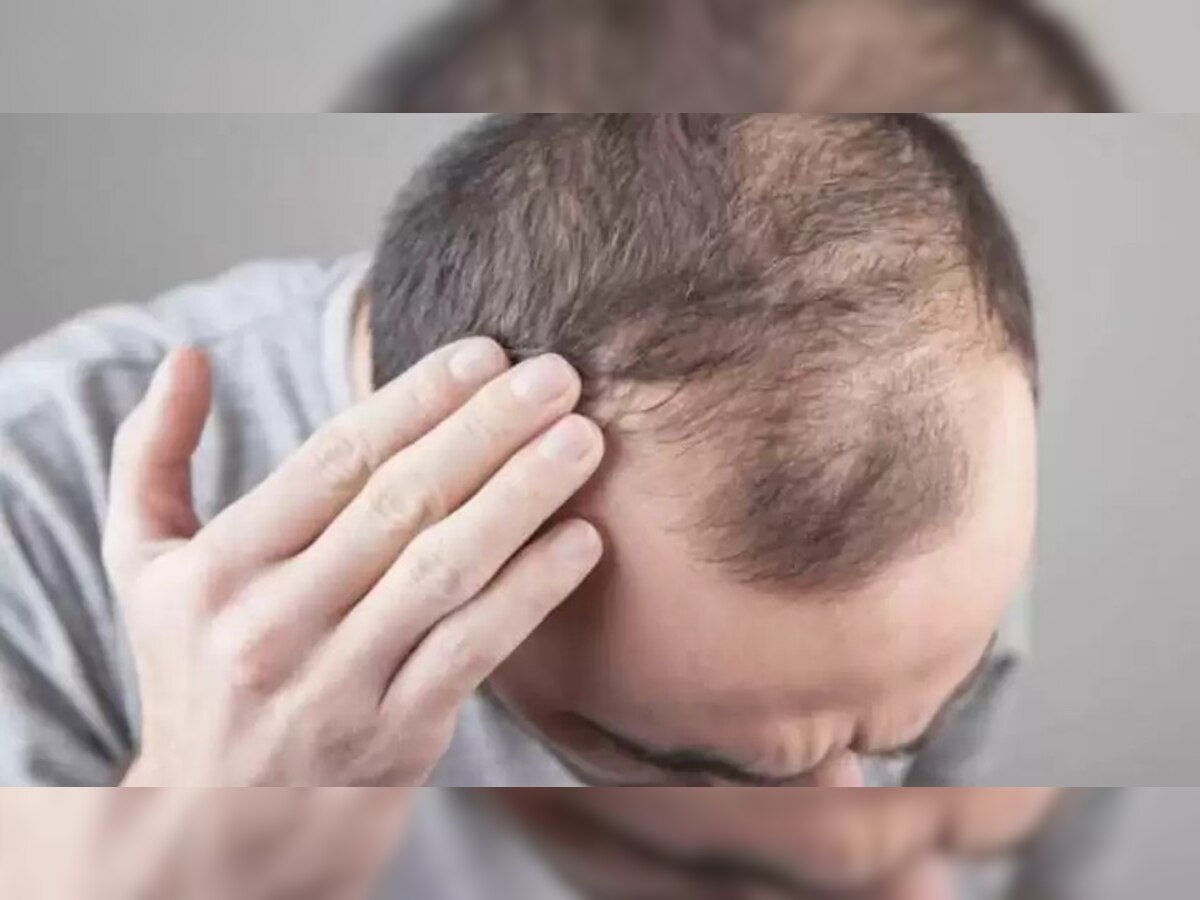 Hair Fall In Men: जानें पुरुषों की कौन सी आदतें बनती हैं गंजेपन की वजह