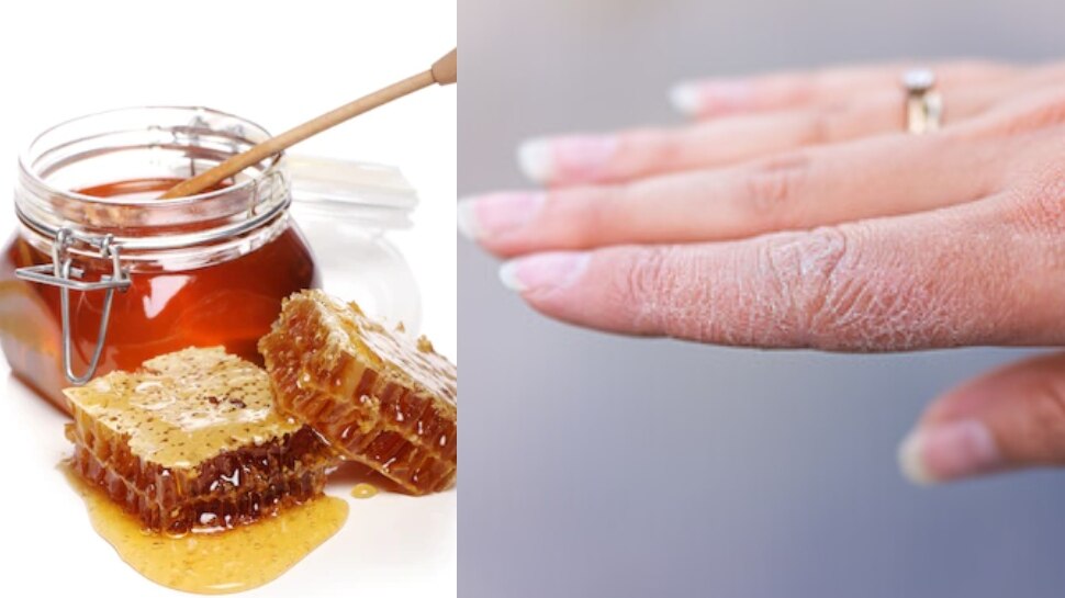 cracked hands healing home remedies get soft and moisturize skin