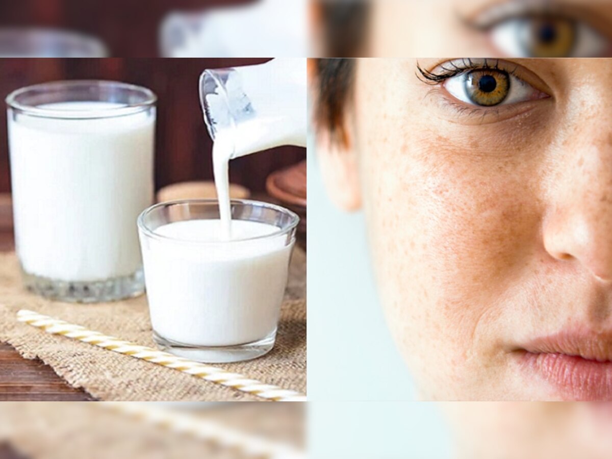 How to remove dark spots on face naturally: चेहरे की झाइयों का काल है 1 चम्मच छाछ, बस ऐसे करना होगा इस्तेमाल