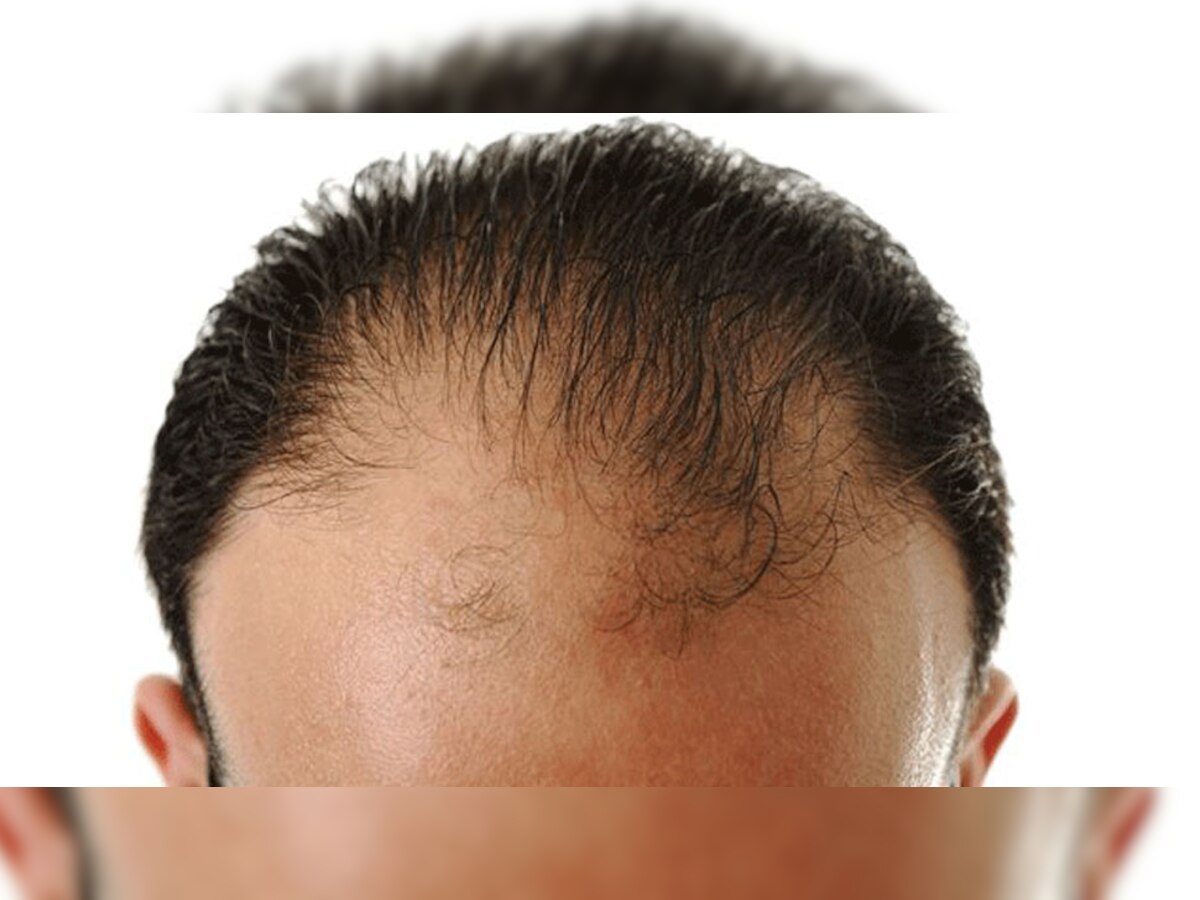 Hair Fall In Men: पुरुष आज ही छोड़ दें ये 3 खराब आदतें, बना देती हैं गंजेपन का शिकार; जानें बालों की देखभाल के तरीके