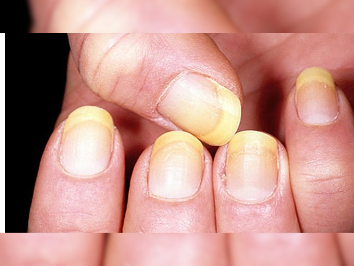 Yellow Nails: ହଳଦିଆ ନଖ ପାଇଁ ଚିନ୍ତିତ କି ? ଆପଣାନ୍ତୁ ଏହି ସବୁ ଘରୋଇ ଉପଚାର