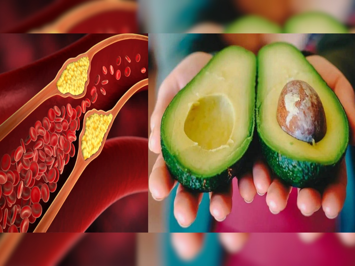 LDL Cholesterol: कोलेस्ट्रॉल कम करने का अचूक उपाय है Avocado, ऐसा दिल को रखता है हेल्दी, पढ़ें चौंकाने वाले फायदे