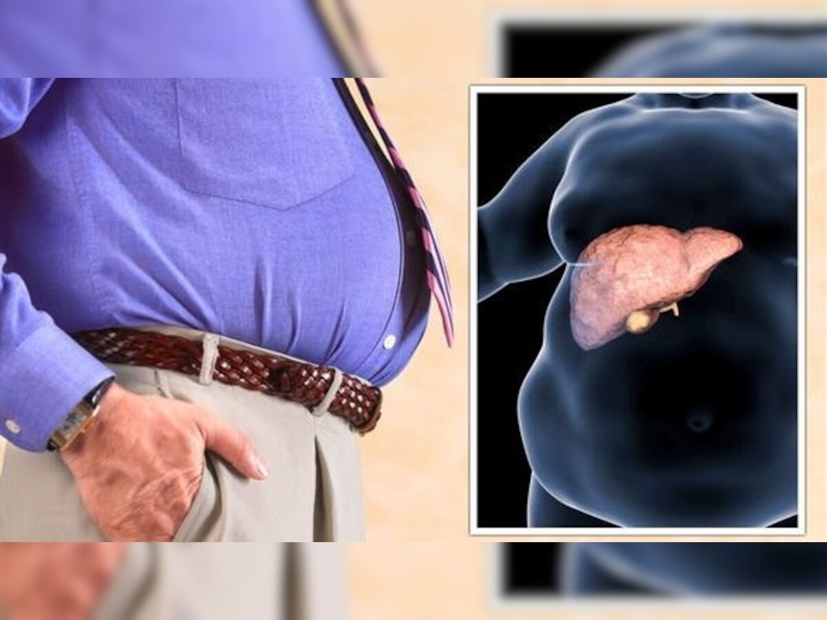 Fatty Liver Disease: कैसे पता करें कि आपको फैटी लिवर डिजीज है? संकेत मिलते ही सतर्क हो जाएं