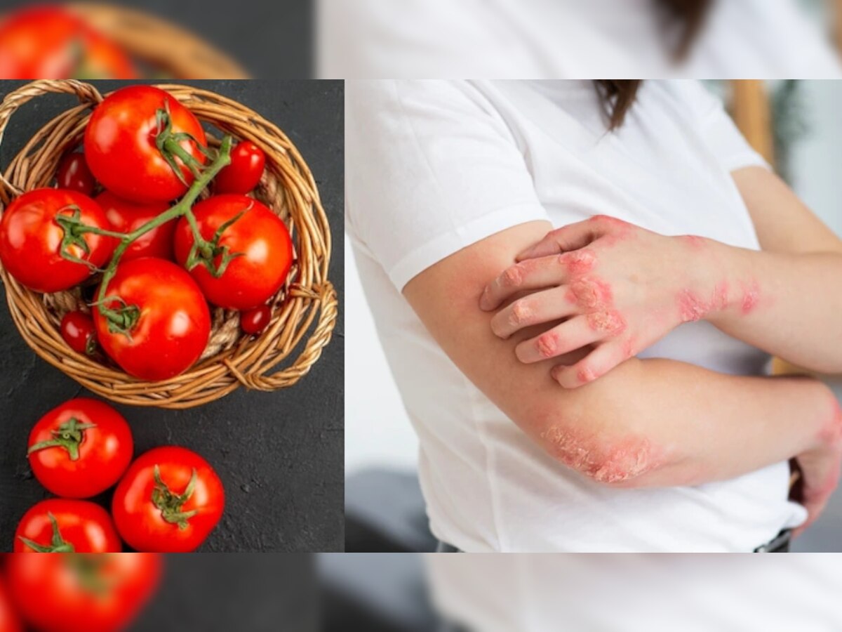 Tomato Side Effects: टमाटर खाने से पहले जान लें नुकसान, बन सकता है इन बीमारियों की वजह