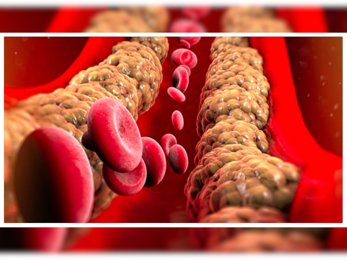 Cholesterol: नसों को पत्थर बना देता है खराब कोलेस्ट्रॉल, इन तरीकों से करें कंट्रोल
