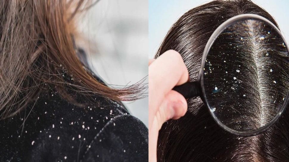 Tips To Remove Dandruff: रूसी की समस्या में बरतें ये 6 सावधानियां, Dandruff से मिल जाएगा आसानी से छुटकारा