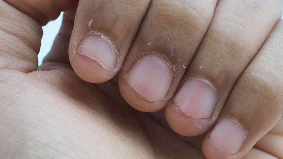 Swollen Cuticles Cuticles Problem on Finger How Do I Stop The Skin Around My Nails From ...