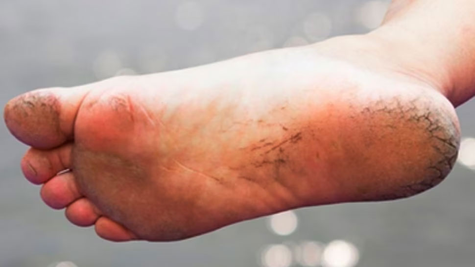 Cracked Heels: फटी एड़ियों की वजह से बिगड़ रही पैरों की खूबसूरती, ऐसे पाएं मुलायम पांव
